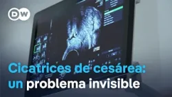 ¿Infertilidad y dolor tras una cesárea?