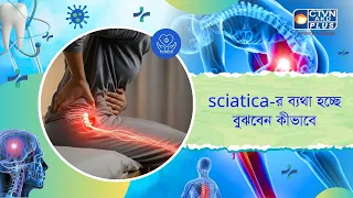 ভেরিকোজ শিরা কি,কেন হয়,কাদের হয়