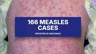 Wisconsin health officials confirm 2 new measles cases in Vernon County, bringing 2026 total to 166