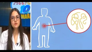 Gastroenteritis: especialista explica síntomas y tratamiento de la inflamación digestiva