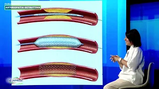 CHE IMPRESA POCKET - OBSTRUCTIVE ARTERIOPATHY