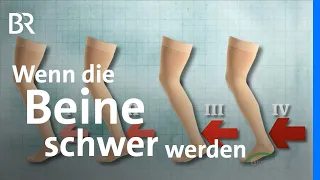 Kompressionsstrümpfe: Hilfe bei Venenerkrankung wie Krampfadern und Unterstützung beim Sport | BR