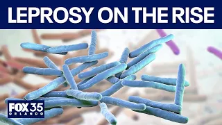 Florida leprosy cases are on the rise