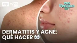 Dermatitis, hongos y acné en niños y adolescentes: lo que debes saber | Más conectados