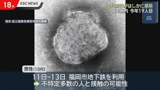 Teenage male infected with measles in Fukuoka City, 19th case this year
