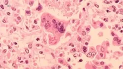 Highly-contagious measles case confirmed in one Bay Area county, health officials say