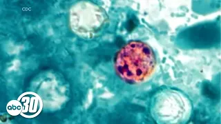 Cyclosporiasis case in Fresno County not linked to outbreak, officials say