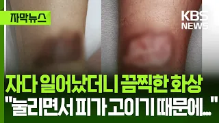 [Subtitled News] Woke up with horrific burns after sleeping: "Because the pressure causes blood t...