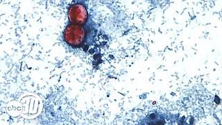Cyclosporiasis cases hit nearly 12,000 in United States