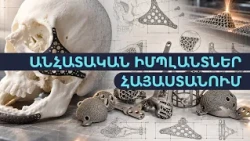 Հայաստանում ստեղծում են անհատականացված իմպլանտներ. ինչպե՞ս