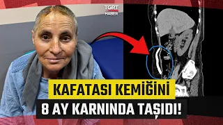 Life-Saving Extraordinary Surgery! She Carried Her Skull Bone in Her Abdomen for 8 Months - TGRT ...