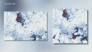More than 500 cyclospora cases reported in Illinois as CDC continues to investigate lettuce link