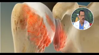 Dr. René Urroz explains symptoms and treatment of osteoarthritis
