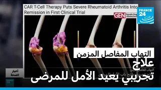 التهاب المفاصل المزمن.. علاج تجريبي يفتح باب الأمل للمرضى