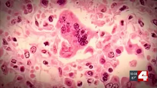 St. Louis County resident diagnosed with measles, first case in 20 years