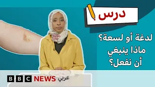لدغة أو لسعة؟ إليكم ما يجب أن نفعله | الإسعافات الأولية | درس