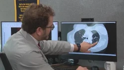Pope Leo has lung cancer. Local doctor explains diagnosis and next steps | Medical Watch