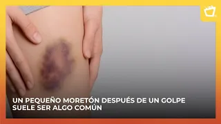 What Causes Bruises to Appear?