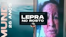MILAGRE: LEPRA NO ROSTO (especial 28 anos de IMPD) MILAGRE: LEPRA NO ROSTO (especial 28 anos de IMPD)