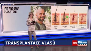 Toužíte po hustých vlasech? Vše, co potřebujete vědět o transplantaci!