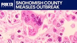 Snohomish County measles outbreak grows to six cases, health officials say | FOX 13 Seattle Snohomish County measles outbreak grows to six cases, health officials say | FOX 13 Seattle