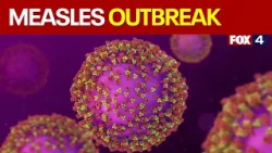 Multiple cases of measles reported in Rockwall