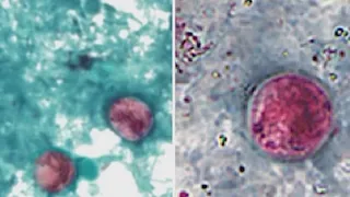 'Diarrhea parasite' cases in NY continues to rise: what to know