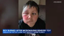 Suburban boy severely burned after following TikTok trend