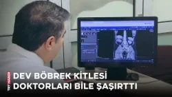 Dev böbrek kitlesi doktorları bile hayrete düşürdü