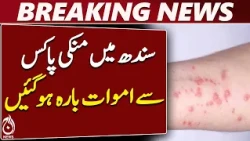 Monkeypox Pakistan | Sindh Health Update | Monkeypox Cases | Health News - Aaj News