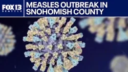 Measles outbreak declared in Snohomish County after 3 kids test positive | FOX 13 Seattle