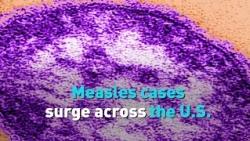 Measles cases surge across the U.S. as outbreaks grow