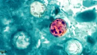 Update on Cyclospora outbreak nationwide