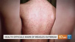 Florida health officials warn of measles outbreak