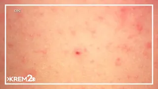 Measles cases, deaths on the rise nationwide