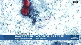 DOH confirms 5th cyclosporiasis case in Hawaii