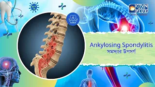 Ankylosing Spondylitis সমস্যার উপসর্গ। Health and Wellness