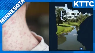 Measles case confirmed in Fillmore County