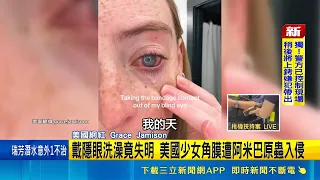 Teen Goes Blind After Showering in Contact Lenses: Parasitic Infection Devastates Cornea. Acantha...