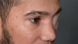 State and Police ordered to compensate young man who lost an eye in ESMAD attack