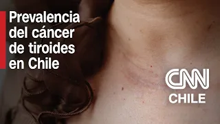 ¿Cuándo consultar Cirujano detalla síntomas del cáncer de tiroides