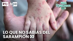 Sarampión: síntomas, riesgos y prevención temprana | Más conectados