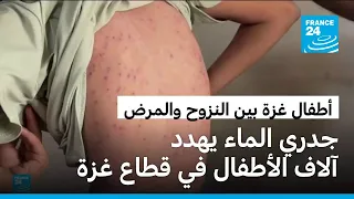 جدري الماء يفتك بأطفال النازحين في غزة وسط تدهور الأوضاع الصحية