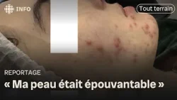« Microneedling » à la maison : les dangers réels derrière la tendance TikTok | Tout terrain