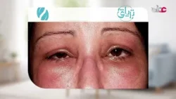 الشرى مرض جلدي يظهر على شكل انتفاخات أو بقع حمراء مع حكة شديدة، تختفي وتعود خلال ساعات.