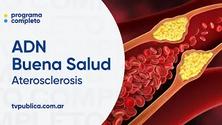 Atherosclerosis and Its Complications - ADN Buena Salud