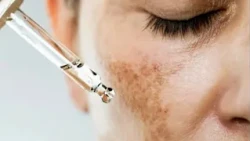 Melasma: What Is It and What Are Its Main Causes?