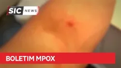 Sobe para 17 o número de casos de MPOX em Rondônia Sobe para 17 o número de casos de MPOX em Rondônia