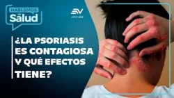 ¿La psoriasis es contagiosa? Mitos y verdades explicados | Hablemos De Salud?| Ecuavisa