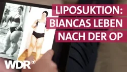 Chronische Fettverteilungsstörung: Schmerzfrei leben nach Fettabsaugung | Frau TV | WDR